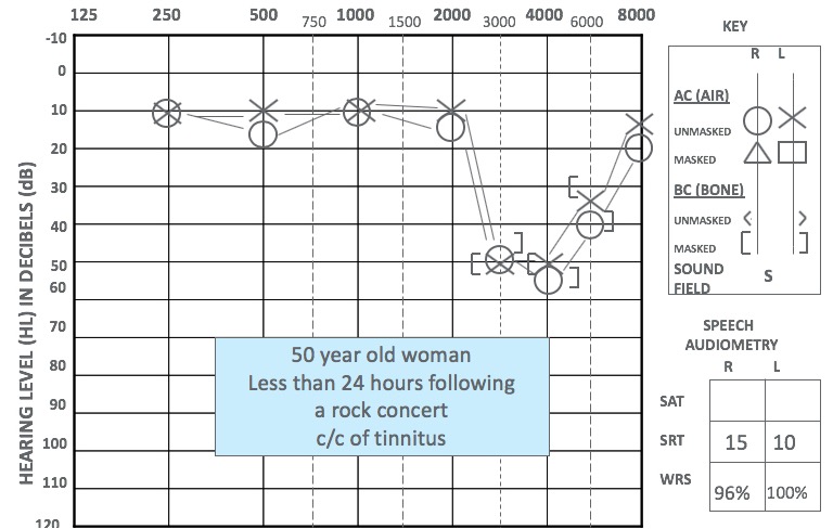 Clinical audiogram showing typical noise damage